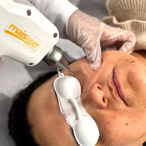 Tecnologia Maislaser em tratamento dermato estético